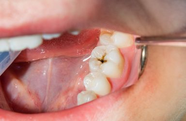 Desarrollan prueba casera puede advertir sobre riesgos de caries