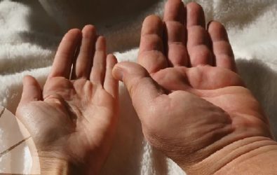 Fármaco muestra tasas de control 70% de síntomas de acromegalia Fármaco muestra tasas de control 70% de síntomas de acromegalia