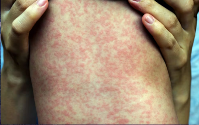 Rep. Dominicana emite alerta epidemiológica por sarampión