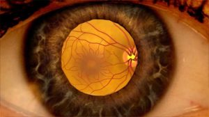 ¿Qué es el edema macular y quienes pueden padecerlo?