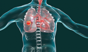 Diagnóstico temprano y avances reducen muerte cáncer pulmón