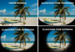 Glaucoma, ladrón silente visión