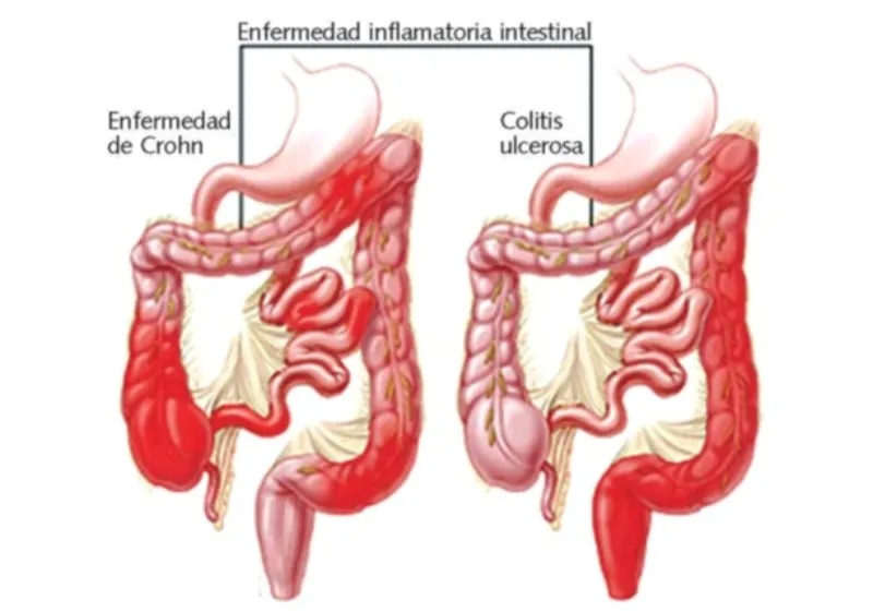 Control dolencias inflamatorias intestinales es difícil | AlMomento.net Control dolencias inflamatorias intestinales es difícil | AlMomento.net