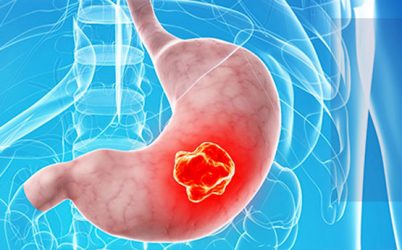 Estudio prevé millones casos de cáncer gástrico a nivel mundial Estudio prevé millones casos de cáncer gástrico a nivel mundial