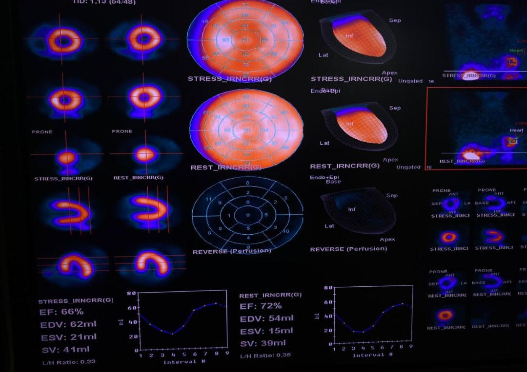 CEDIMAT realiza gammagrafía cardíaca con Regadenoson imagen