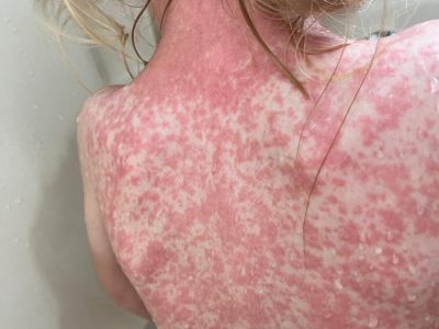 Sarampión en RD: un brote a la vista imagen