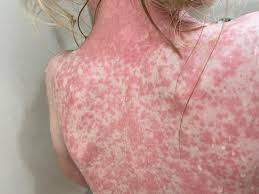 Sarampión en RD: un brote a la vista Sarampión en RD: un brote a la vista