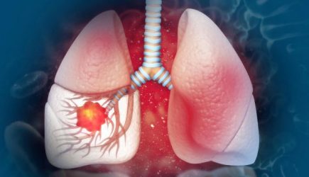 Sociedad Oncología dice 80% cáncer pulmón se asocia tabaco Sociedad Oncología dice 80% cáncer pulmón se asocia tabaco