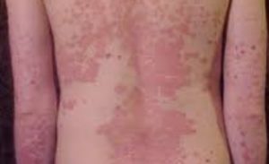Psoriasis: Enfermedad crónica que afecta más allá de la piel