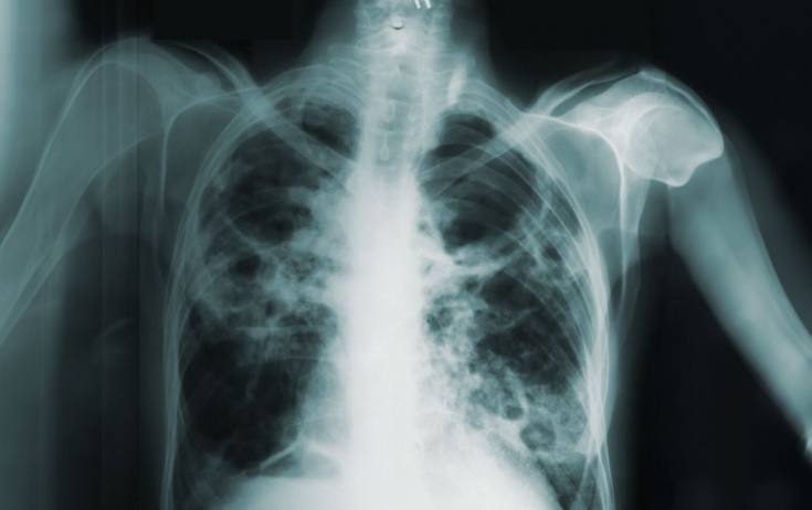 Salud incorpora dos equipos para diagnosticar tuberculosis imagen
