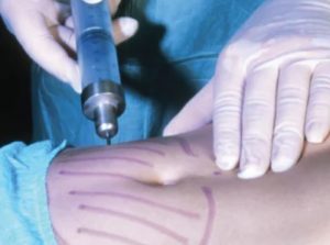 Tendencia estética que utiliza tejido humano de fallecidos
