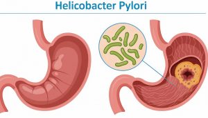 Helicobacter pylori estaría asociado al cáncer colorrectal Helicobacter pylori estaría asociado al cáncer colorrectal